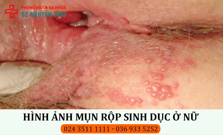 Hình ảnh mụn rộp sinh dục ở mép âm đạo nữ giới
