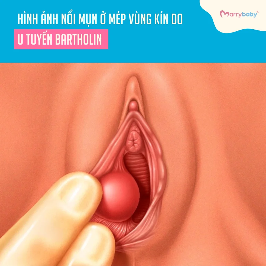 Nổi mụn ở mép vùng kín nữ giới: Cách điều trị - MarryBaby