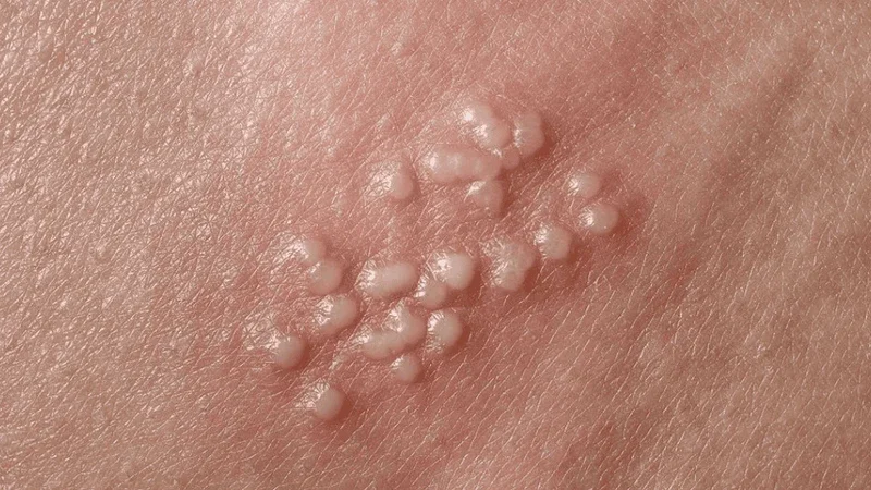 Nguyên nhân nổi mụn ở mép vùng kín nữ và cách phòng ngừa 2