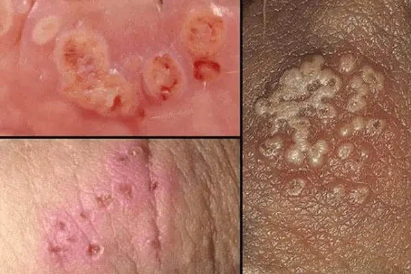 Hình ảnh nổi mụn ở vùng kín nữ giới do mụn rộp sinh dục