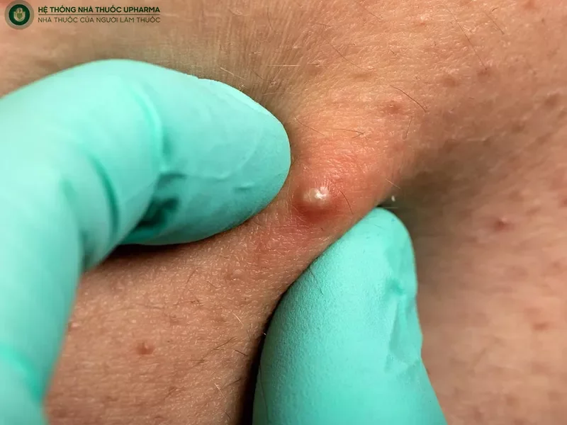 hình ảnh nổi mụn ở vùng kín nữ - mẫu 42