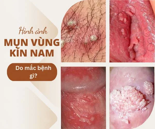 nguyên nhân vùng kín nổi mụn