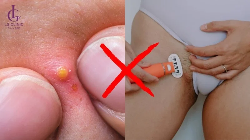Hình ảnh nổi mụn ở vùng kín nữ: Dấu hiệu và cách xử lý an toàn