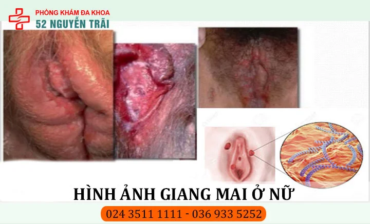 Hình ảnh giang mai ở mép âm đạo nữ giới