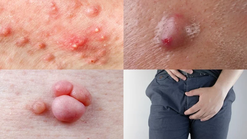 Hình ảnh nổi mụn ở vùng kín nam giới