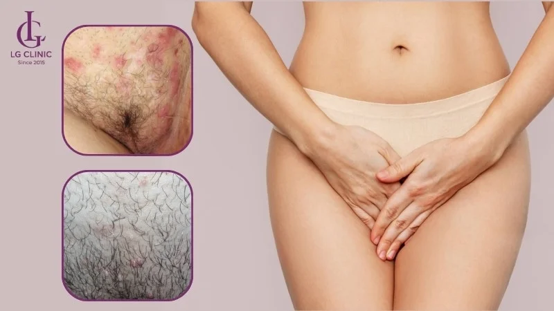ngyên nhân nổi mụn ở vùng kín nữ