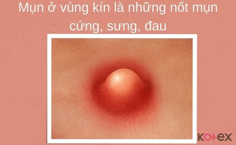 Nổi mụn ở vùng kín: Nguyên nhân & Cách điều trị - Kotex