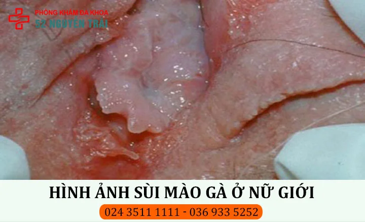 Hình ảnh sùi mào gà ở mép âm đạo nữ giới
