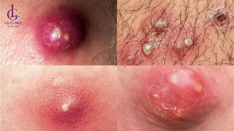 nổi mụn mủ ở vùng kín nữ