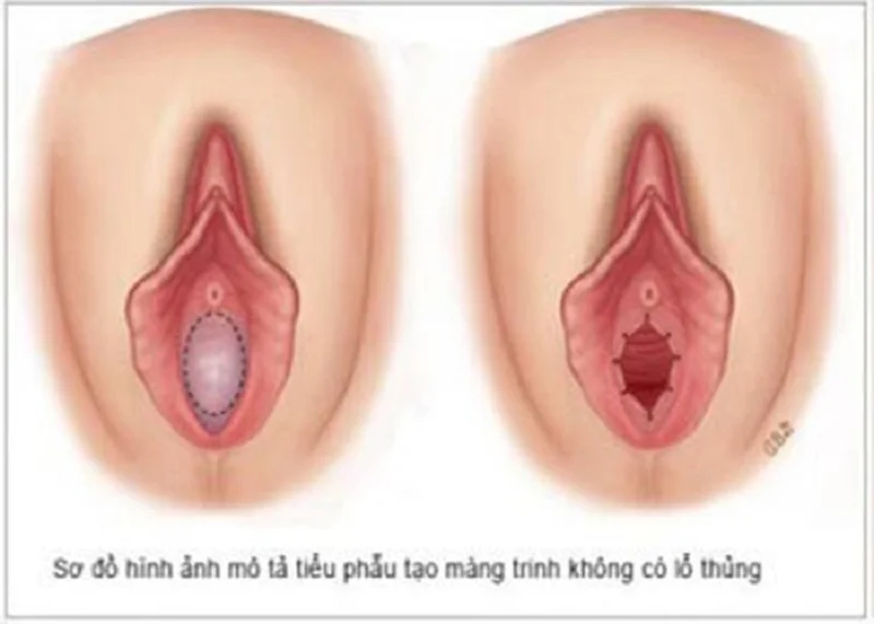 Một số bất thường có thể gặp ở màng trinh mà bạn gái nên biết