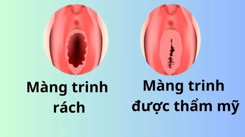 Cách nhận biết màng trinh còn hay rách? Nguyên nhân rách màng trinh (2)