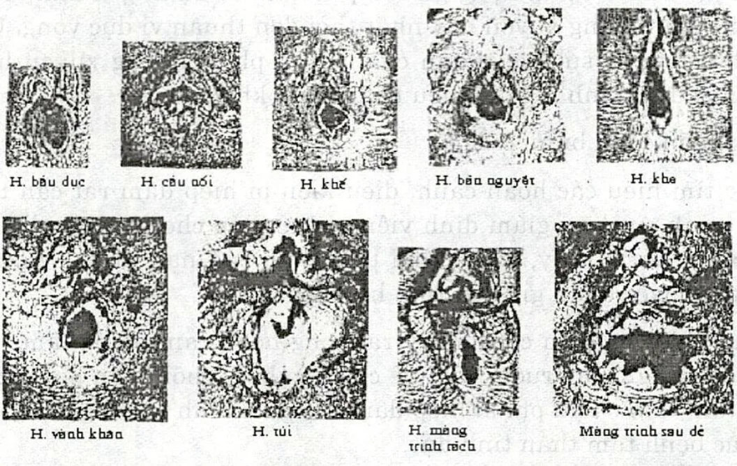 Tuyển chọn hình ảnh màng trinh bình thường — hình 5