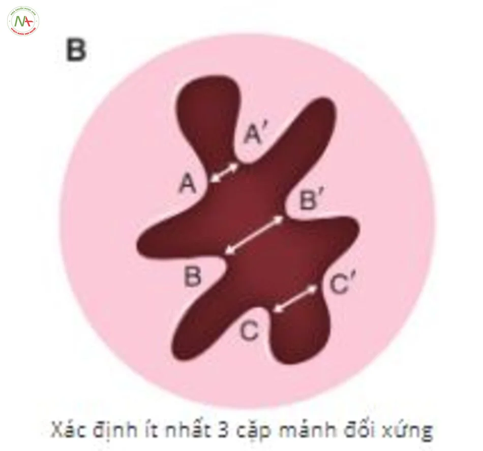 hình ảnh màng trinh bình thường - mẫu 43