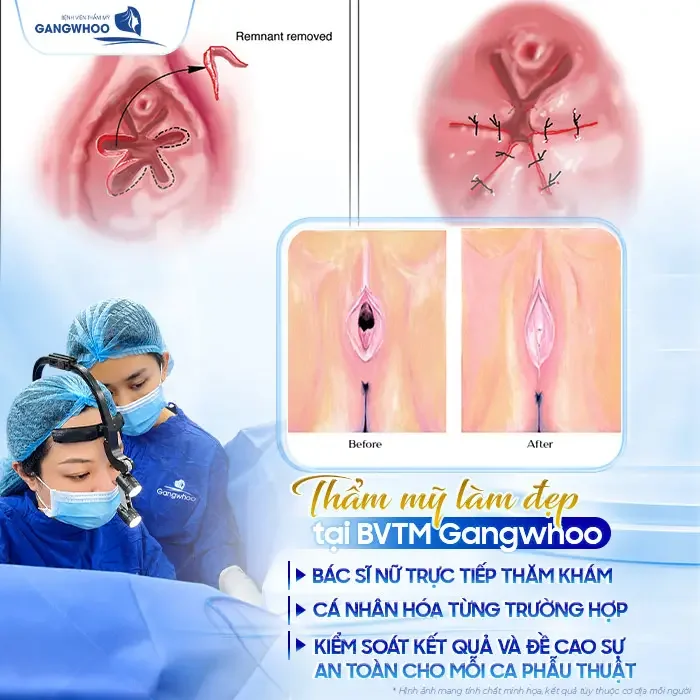 Vá Màng Trinh Được Không Khi Đã Quan Hệ Nhiều Lần? Bác Sĩ Giải Đáp (2)