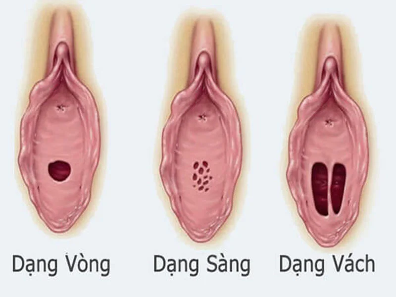 Một số bất thường có thể gặp ở màng trinh mà bạn gái nên biết