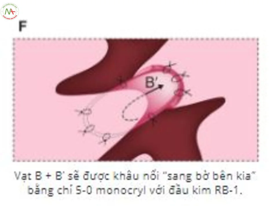 hình ảnh màng trinh bình thường, hình 91